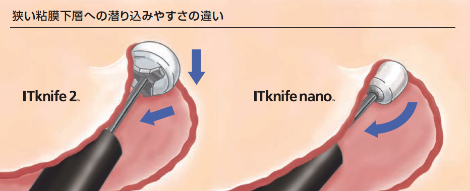 ディスポーザブル高周波ナイフ ITknife nano|製品情報